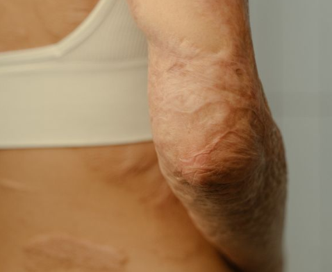 Patient and Caregiver Education for Burn Wound Management